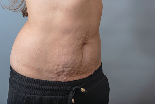 Close up of loose abdominal skin with stretch marks and wrinkles shown for dermatology and skin care concepts on gray background