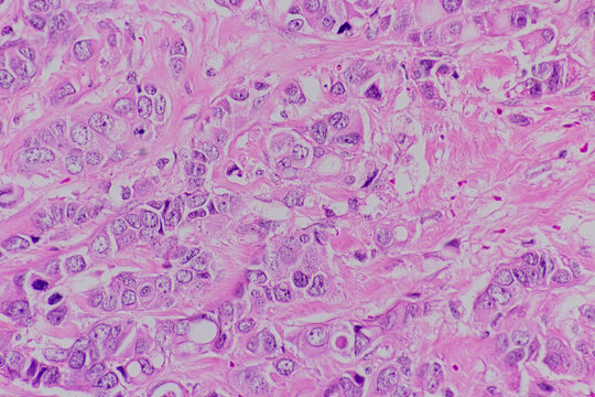 Backgrounds of human cells tissue of lung human under the microscope in pathology lab.View in microscopic of ductal cell carcinoma, adenonocarcinoma from human breast cancer, tissue section by H and E