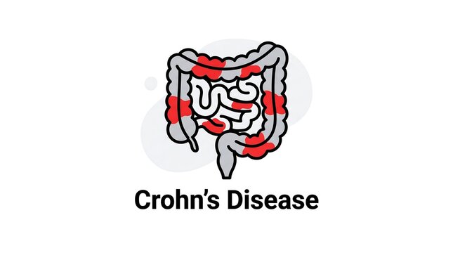 Crohn's disease illustration showing inflamed intestines with red patches