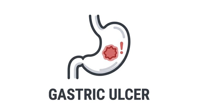 Gastric ulcer illustration showing stomach lining damage with exclamation mark