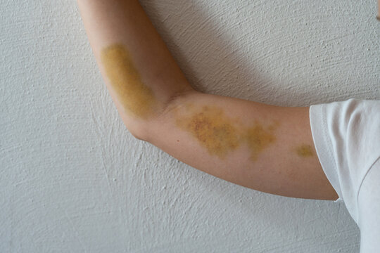 A human arm bent against a textured wall, displaying a prominent, discolored bruise resulting from blunt trauma, currently in the healing stage.