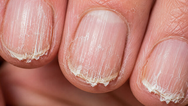 Close up of dry, brittle fingernails with peeling edges and damaged cuticles