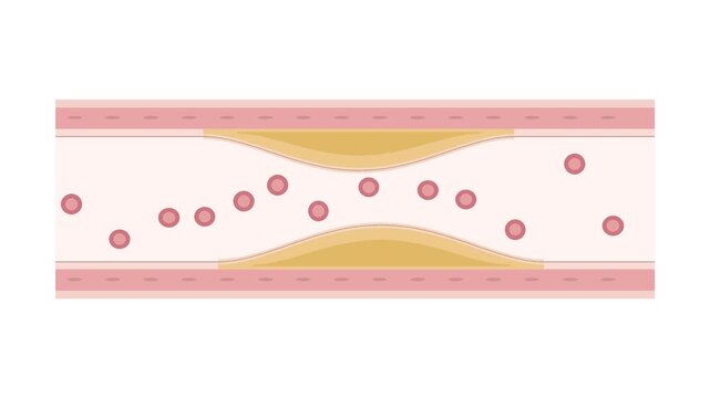 2D medical animation of atherosclerotic plaque growing within artery walls, progressively narrowing the lumen as red blood cells flow through. White background, no text.