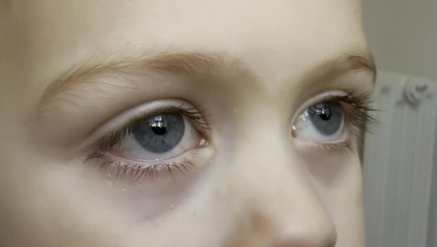 Close up of one infected red eye of a toddler boy 