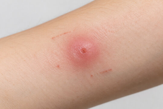 Red swollen mosquito bite on forearm skin, insect bite irritation and allergy