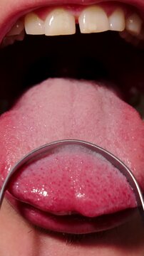 Adult removes plaque from tongue using metal oral cleaner in macro view. Subject performs thorough mouth care routine by scraping white coating toward tip with calm deliberate hand movement.