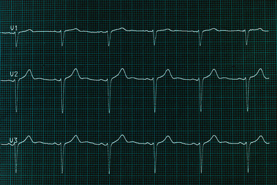 Paper printout of an Electrocardiogram  post-processed to resemble a cyan-colored screen display