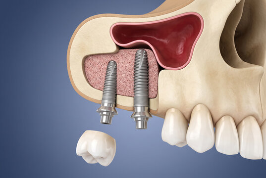 3D medical illustration of sinus lift procedure with two dental implants, bone graft and crown in cross-section cutaway of upper jaw for dental education