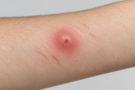 Red swollen mosquito bite on forearm skin, insect bite irritation and allergy