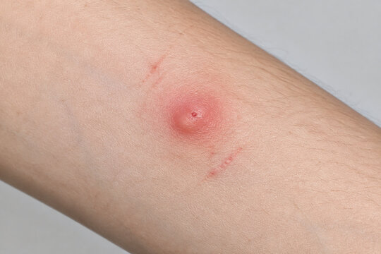 Red swollen mosquito bite on forearm skin, insect bite irritation and allergy