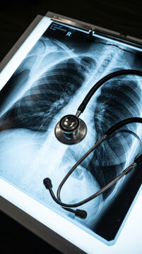 Medical Stethoscope Resting On Illuminated Chest Lungs X Ray