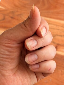 Hand with damaged brittle nails