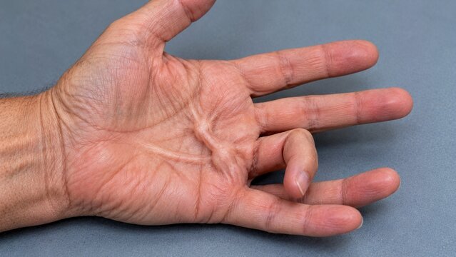 hand with palm facing upward, showing a visible thickened cord beneath the palmar skin extending toward the ring finger and mild fixed flexion of that finger.
