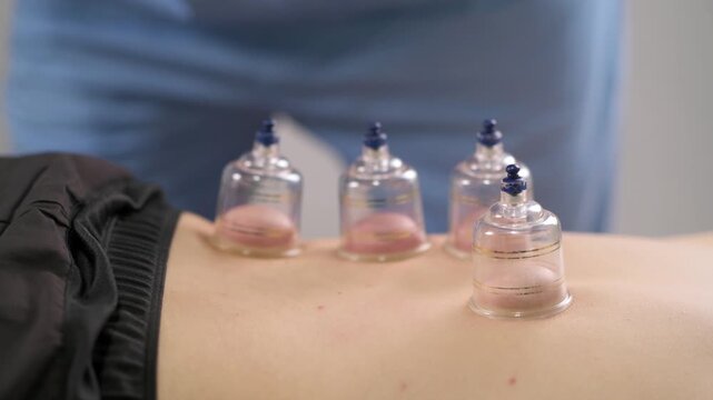 Therapist applying multiple vacuum cups to a patient&rsquo;s back during a rehabilitation treatment focused on muscle tension, relaxation, and physical recovery.