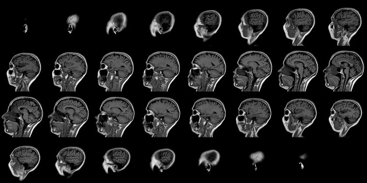High Resolution Gray Scale Magnetic Resonance Tomography Scan Sequence Displaying Longitudinal Sagittal Cross Sections Of A Healthy Human Brain Anatomy And Skull Cavity Structure