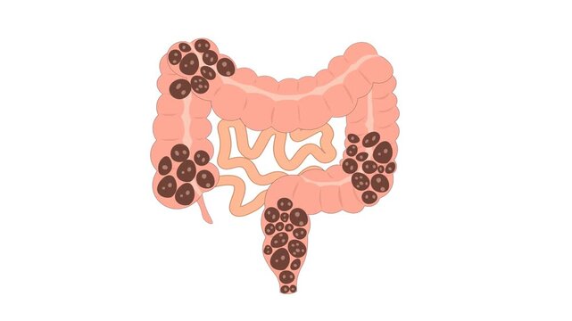 Colonic Constipation Fecal Impaction Vector Animation,stool deposits, highlighting constipation, fecal impaction, bowel obstruction, irritable bowel syndrome (IBS-C), diverticulosis, hemorrhoids