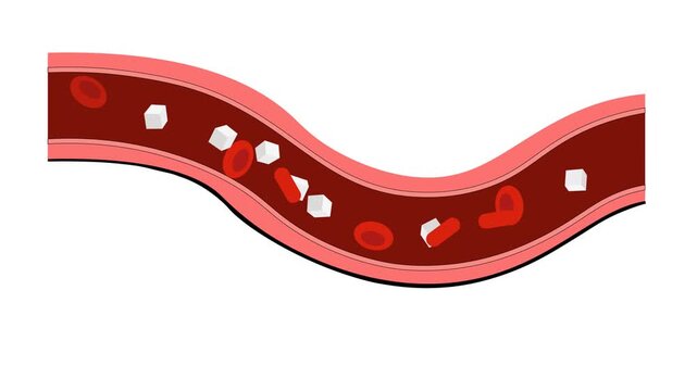 Blood Glucose Hyperglycemia Diabetes Vector Animation diabetes mellitus, hyperglycemia, metabolic syndrome, diabetic ketoacidosis, gestational diabetes, and insulin resistance for endocrinology 