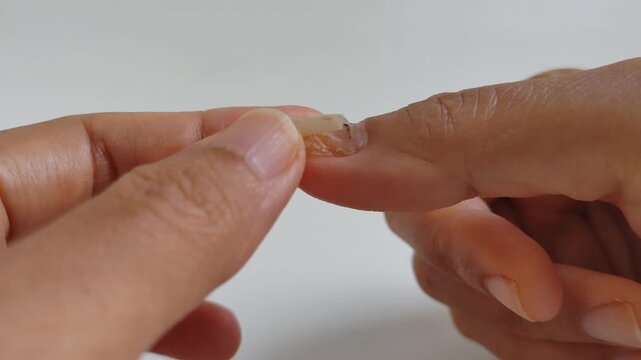 Person pulling or peeling off a damaged and healing thumbnail with injury mark