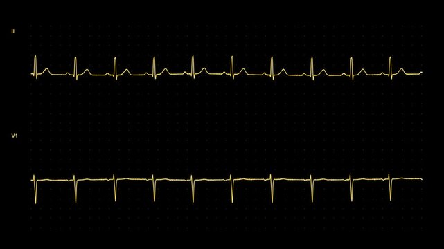 Heart monitor bradycardia to complete heart block then flatline