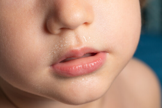 Perspiration beads on upper lip of young child with fever, closeup of nose and slightly parted pink mouth, damp skin caused by overheating in warm summer heat