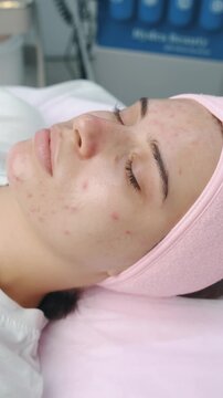 young woman with closed eyes lying on treatment bed showing facial acne and redness during skincare session in