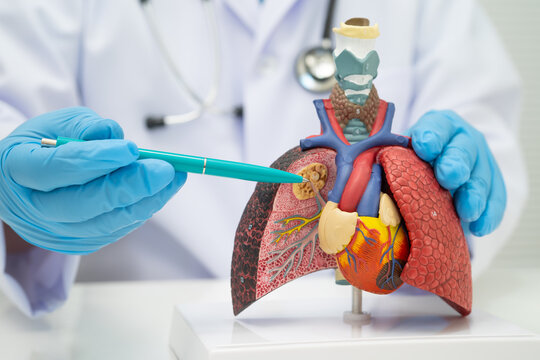 Pneumonia, lung cancer, Asian doctor holding human anatomy model for study diagnosis and treatment in hospital.