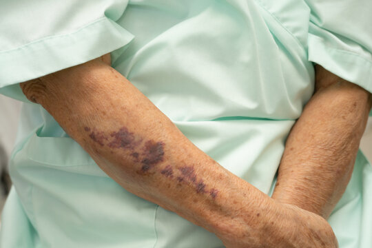 Ecchymosis, elderly bleeding on her arm after taking aspirin.