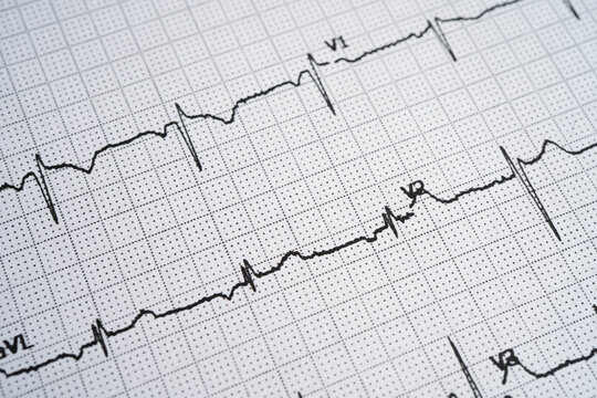 Electrocardiogram ECG, heart wave, heart attack, cardiogram report.