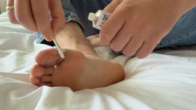 Individual applying ointment to a foot with visible hematoma, using a cotton swab and tube of cream while seated on a bed with white bedding