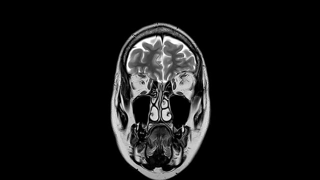 Stop Motion Series Of Gray Scale Magnetic Resonance Tomograms Showing Coronal Sections Of Healthy Human Brain And Cranial Cavity