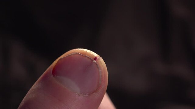 A macro close-up focusing on a small healing slit cut beginning to scab down the center of a thumb tip.