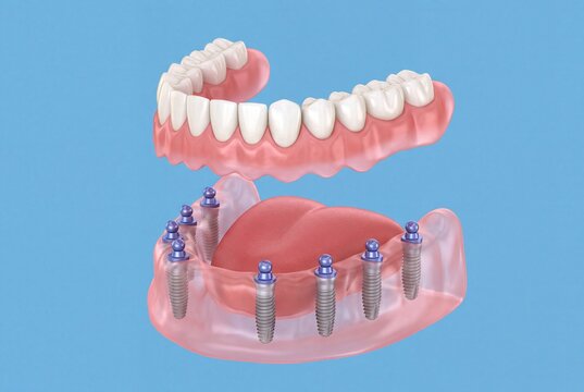 3D illustration of mandibular overdenture supported by eight ball attachment implants, removable lower full denture exploded view on blue background