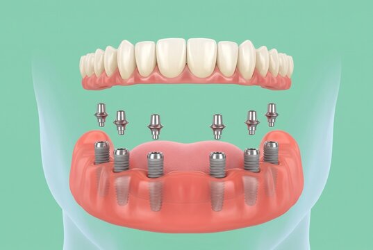 3D illustration of mandibular full arch fixed denture exploded view with six dental implants and titanium abutments on mint green background, implant dentistry concept