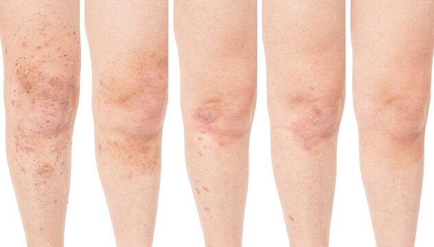Weekly comparison of a thigh skin patch shows fading discoloration and smoother texture, arranged side by side on a transparent background.