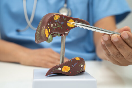 Cirrhosis, Liver cancer, fatty liver, Asian doctor with liver human anatomy model in World Hepatitis Day at hospital.