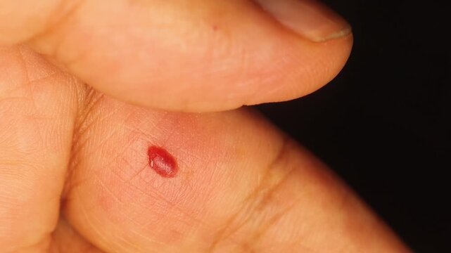 Blood blister and hematoma on finger after trauma, showing skin injury and subcutaneous bleeding. Ideal for medical education, pathology, dermatology, first aid, and workplace safety.