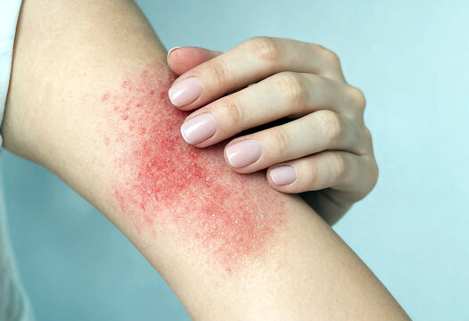 Person holding arm showing red irritated skin rash on forearm with visible discomfort