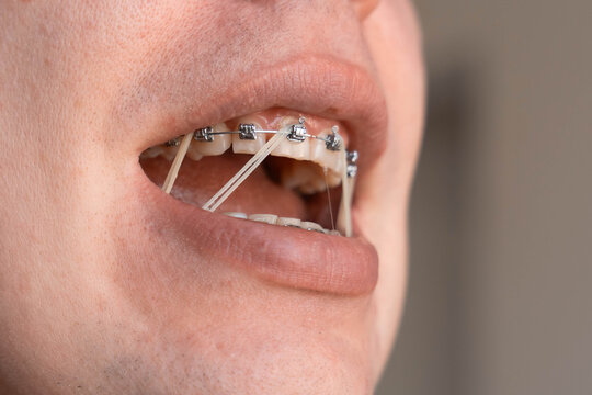 Close up of teeth with metal braces and orthodontic elastics inside an open mouth. Elastic bands help correct bite alignment during orthodontic treatment