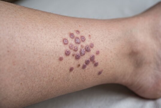 Close-up shot of lichen planus papules on lower leg skin