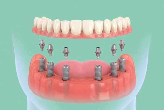 3D illustration of mandibular full arch fixed denture exploded view with six dental implants and titanium abutments on mint green background, implant dentistry concept