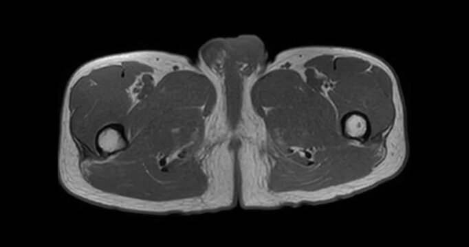 Axial T1 weighted MRI scrolling through the male pelvis from the iliac bones to the hip joints in a patient with benign prostatic hyperplasia.