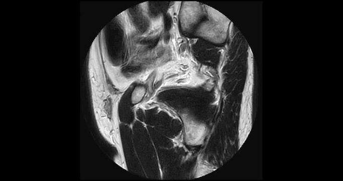 Sagittal T2 weighted MRI scrolling through an enlarged prostate gland with benign prostatic hyperplasia between the bladder and rectum.
