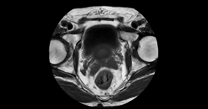 Axial T1 weighted MRI scrolling from the bladder to the prostate apex showing benign prostatic hyperplasia with no suspicious malignant lesion.