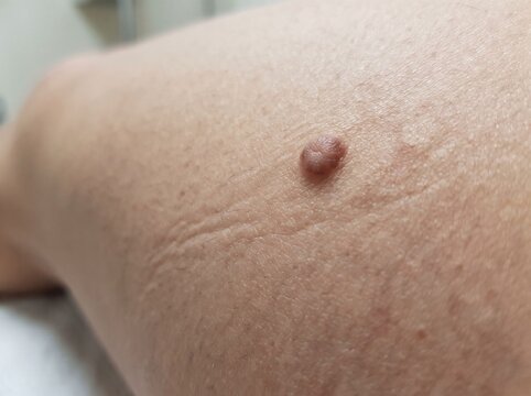 Macro close up of a benign dermatofibroma skin nodule on human leg