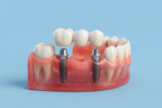 3D render of dental implant bridge with two titanium abutments and ceramic crowns floating above lower jaw model with gums, blue background, for implant dentistry and tooth replacement education