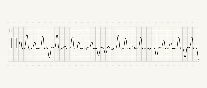 Polymorphic ventricular tachycardia ECG rhythm strip