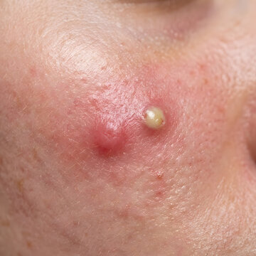 close-up macro photograph of human skin with inflammatory acne, showing redness and mild swelling.