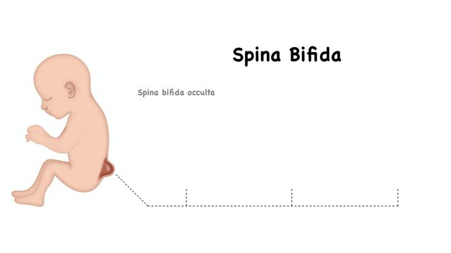 Animation of biology and medical, Illustration of a child with spina bifida, Spina bifida is when a baby's spine and spinal cord, types of spina bifida diagram. The infographic features occulta