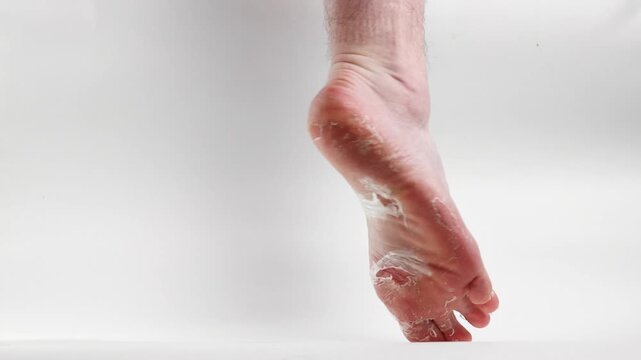 Close-up of a man's leg showing sole with peeling skin. Feet with dry skin and fungal. White background. Side view. Concept of cosmetic skin care and pedicure
