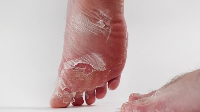 Close-up of man's feet showing severe peeling of the dry skin of the foot. Effect of skin renewal with acidic pedicure cosmetics. White background